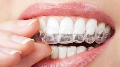 clear aligners on teeth