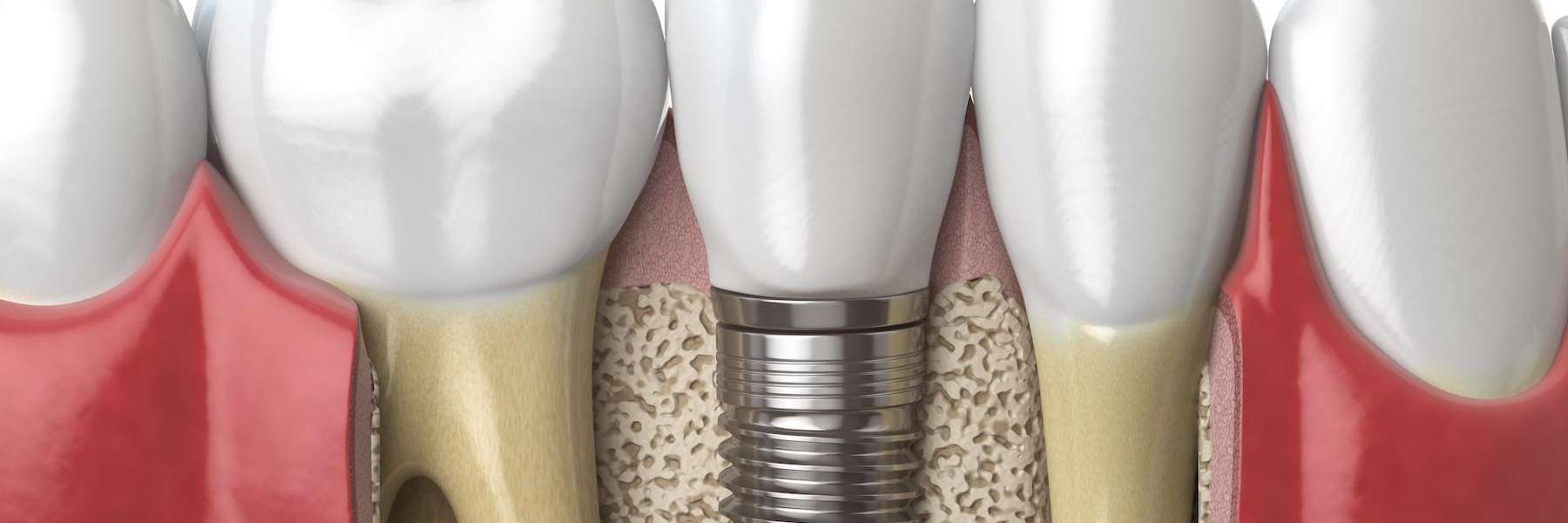 close up of dental implant | dentist arlington wa