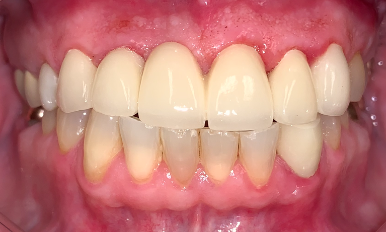 Crown-Bridge-Veneers-After-Image