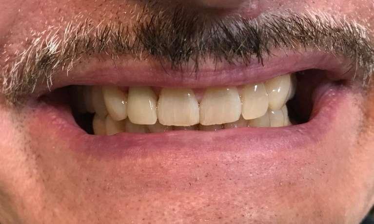 close up of patient's smile after dental crown to replace missing tooth