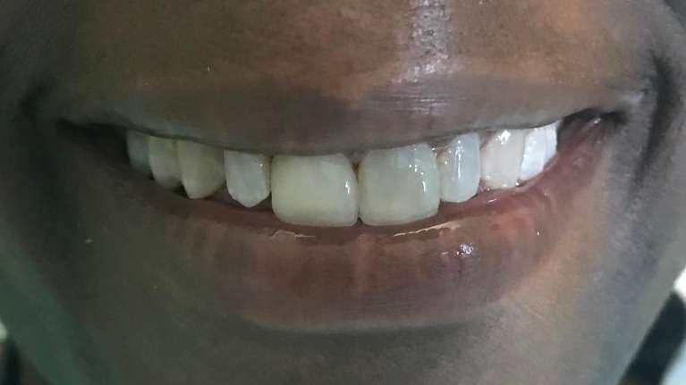 close up of smile after new dental crown