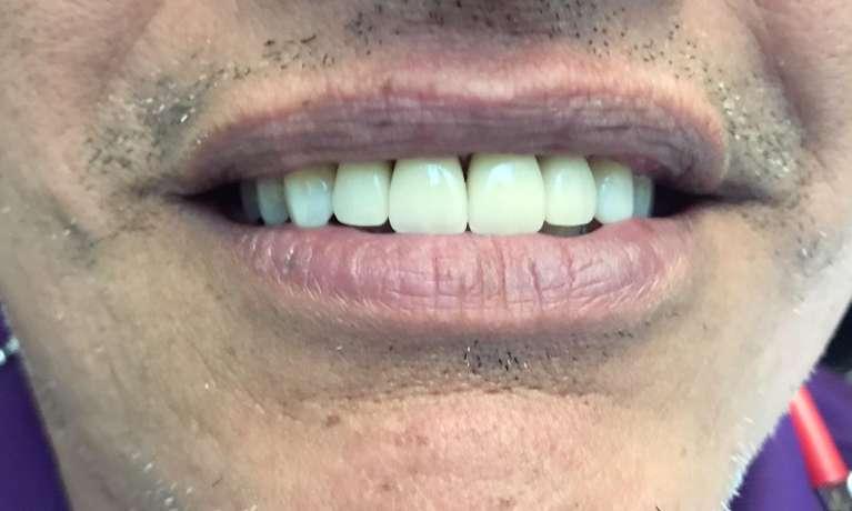 Cosmetic-Crowns-After-Image