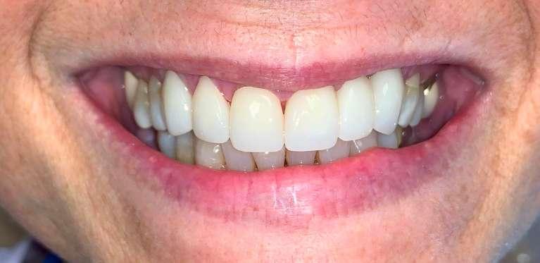 Crown-Implant-After-Image