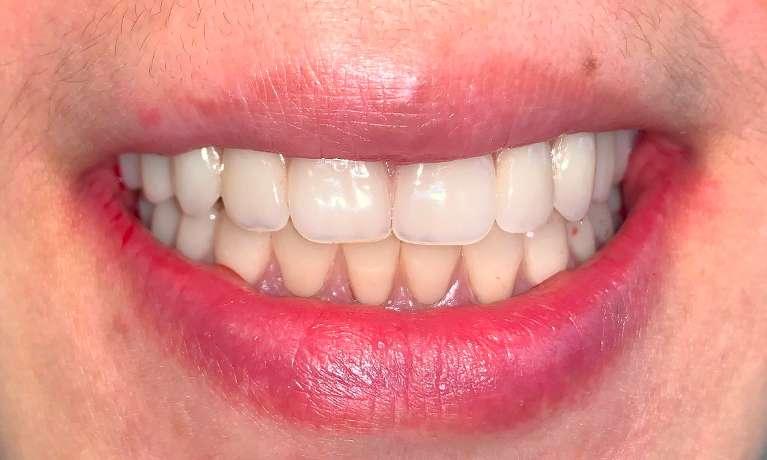 Immediate-Dentures-After-Image
