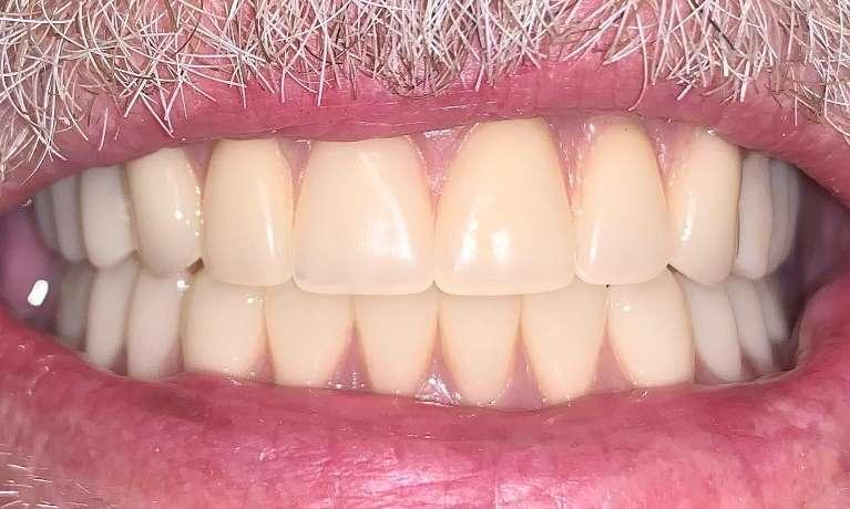 Implant-Supported-Overdenture-After-Image