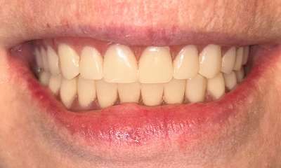Implant-Supported-Overdenture-After-Image