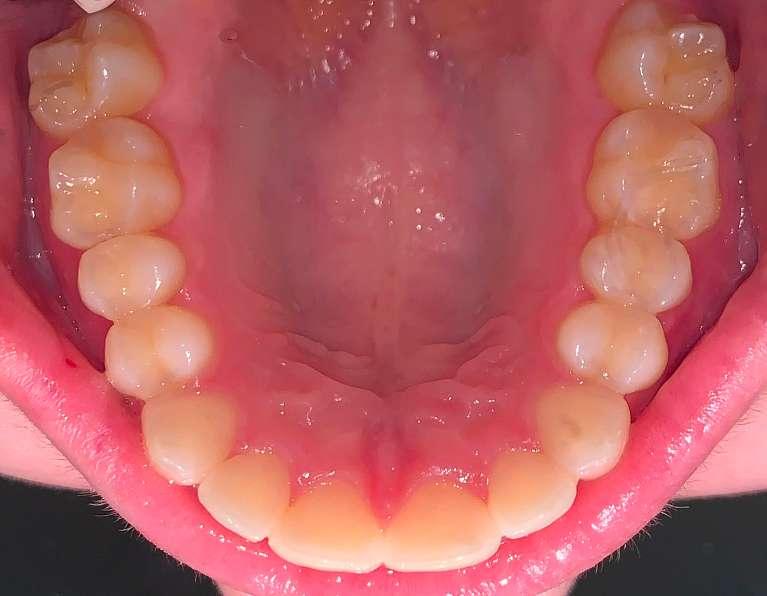 Invisalign-Case-1-After-Image