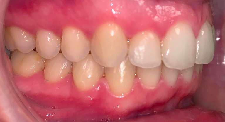 closed tooth gap after invisalign