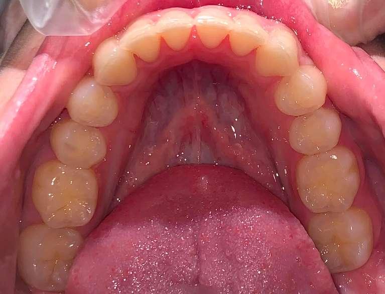 invisalign corrected crooked front teeth