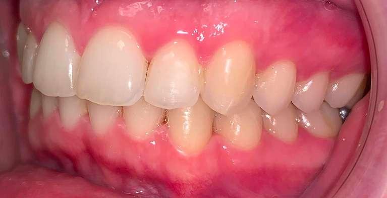 closed tooth gap after invisalign