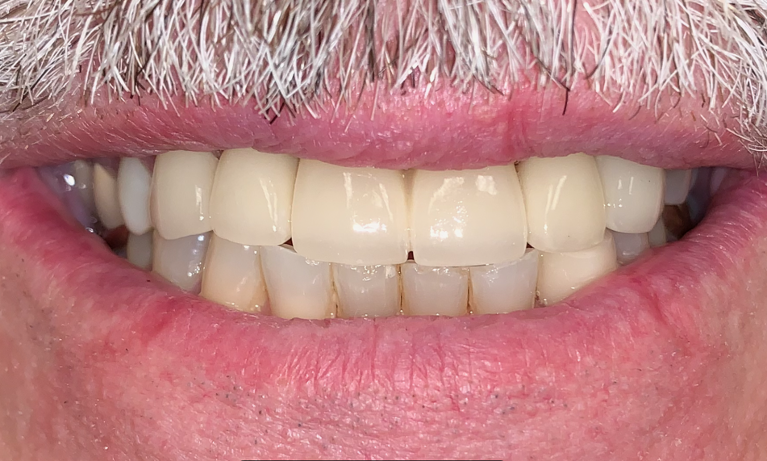 Close up of patient's smile after veneers and crowns