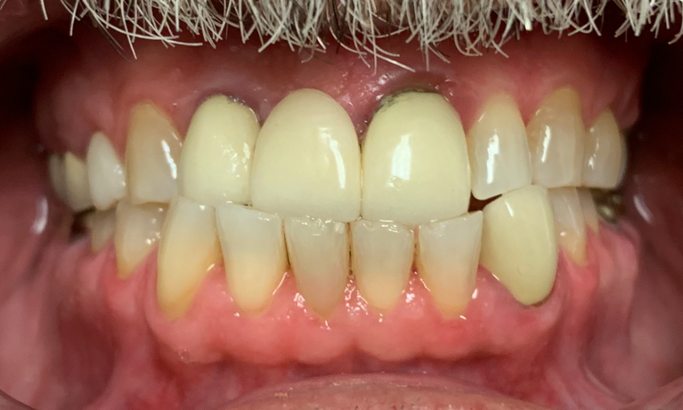 Crown-Bridge-Veneers-Before-Image