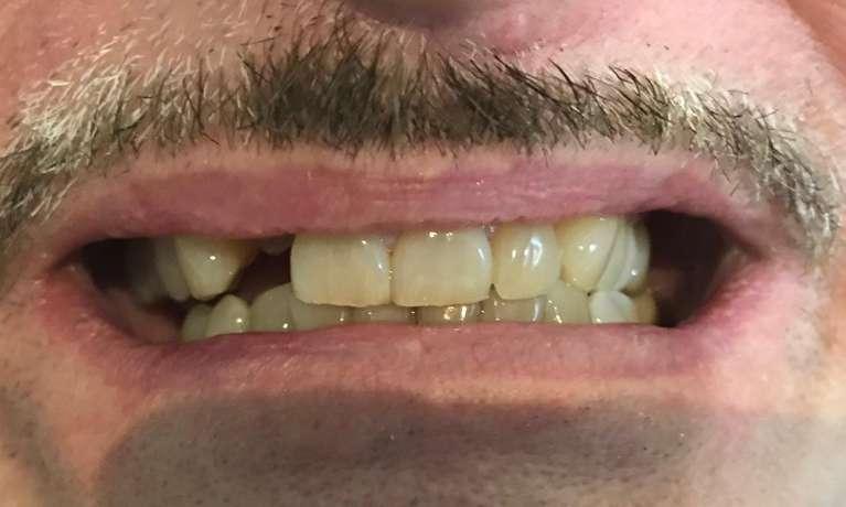 smile with missing front tooth