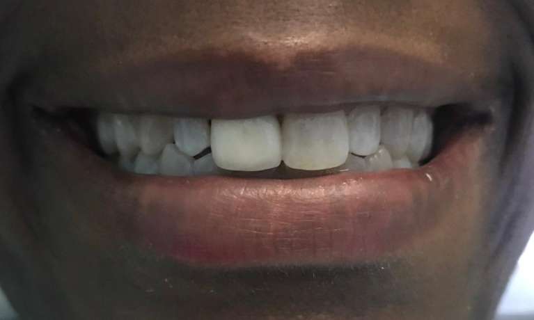 close up of smile before dental crown