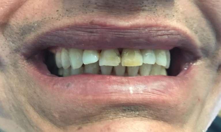 Cosmetic-Crowns-Before-Image