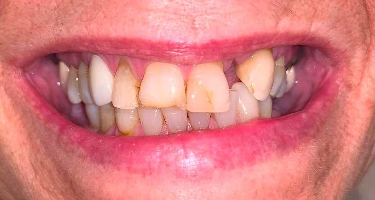 Crown-Implant-Before-Image