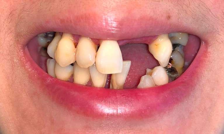 Immediate-Dentures-Before-Image