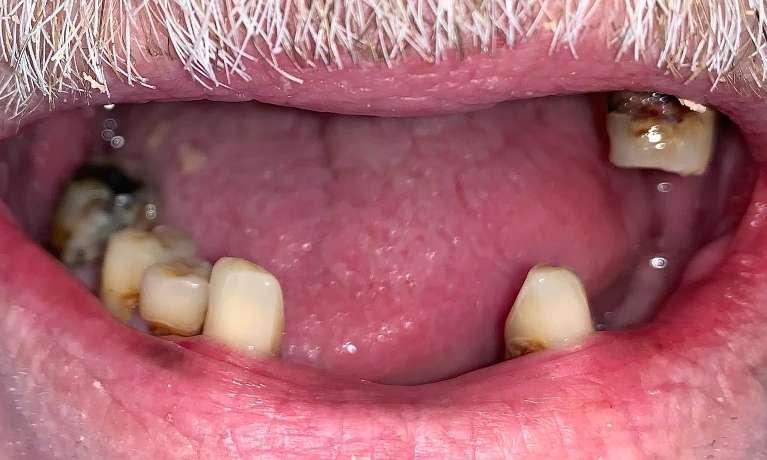 Implant-Supported-Overdenture-Before-Image