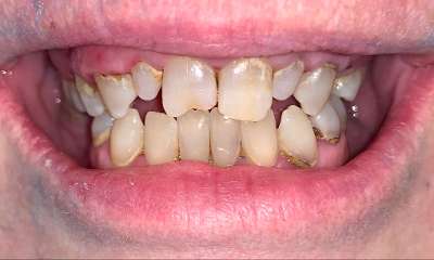 Implant-Supported-Overdenture-Before-Image
