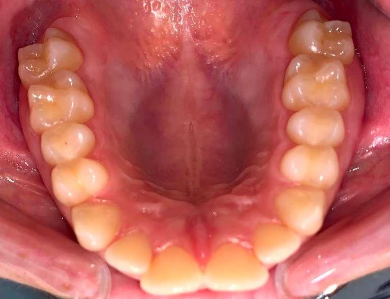 Invisalign-Case-1-Before-Image