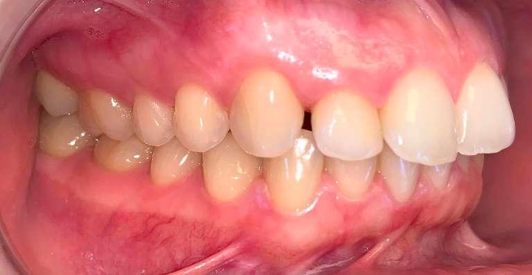 gap between teeth