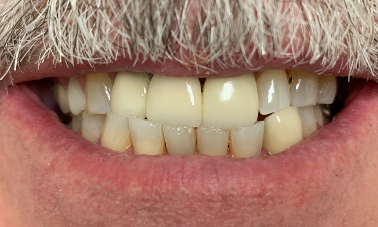 Close up of patient's smile