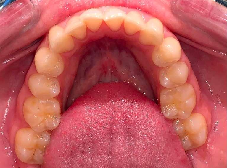 croooked front teeth