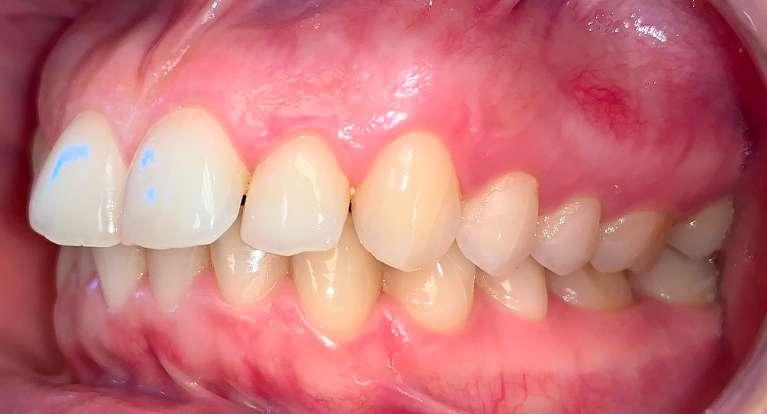 gap between teeth